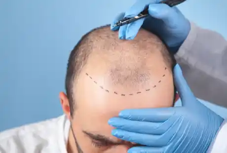 Hair-Transplantation