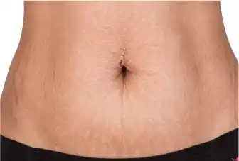 Stretch-Mark